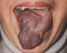 Cavernous Hemangioma Before