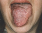 Cavernous Hemangioma Before