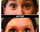 Botox-3-Edmonton