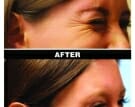 Botox-4-Edmonton