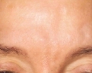 Glabella after