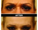 Botox treatment of glabella