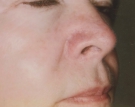 Facial Veins After