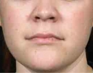 isolaz-acne-treatment-after