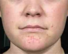 isolaz-acne-treatment-before