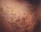31aed-nevus-of-ota