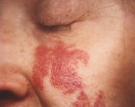 port-wine-hemangioma-1ed