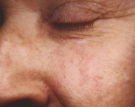 port-wine-hemangioma2ed