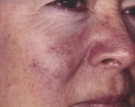 rosacea1aed