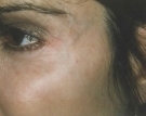 single-facial-vein-1ed