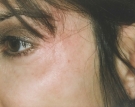single-facial-vein-2ed