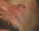 vascular-hemangioma1ed