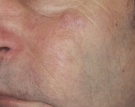 vascular-hemangioma2ed