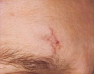 Scars Before