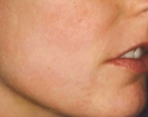 Scars After