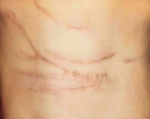 Scars Before