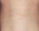 Scars After