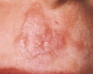 Scars Before