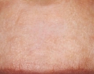 Scars After
