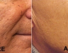 acnescars2