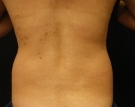 Unwanted Fat Before