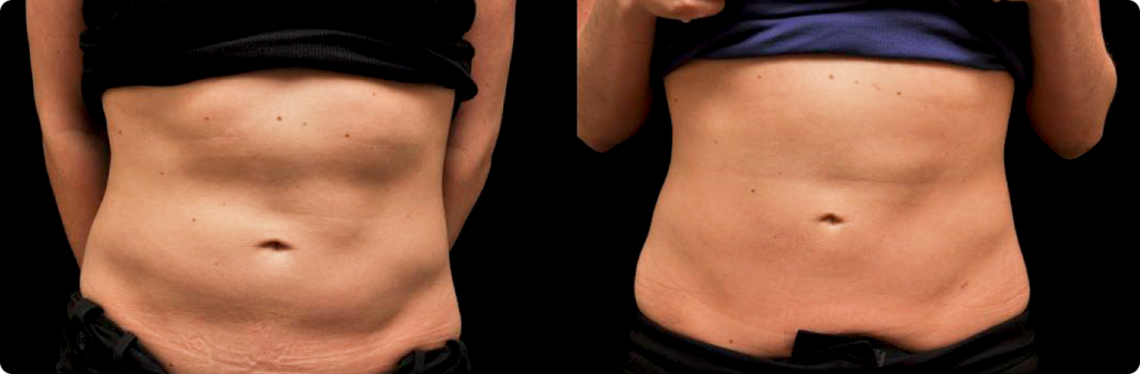 coolsculpting before and after abdomen stomach edmonton