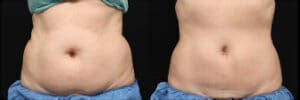 Coolsculpting Edmonton before and after- abdomen and hips