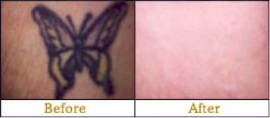 before and after laser tattoo removal Edmonton 