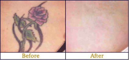 tattoo removal before and after Edmonton 