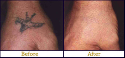 laser tattoo removal before and after