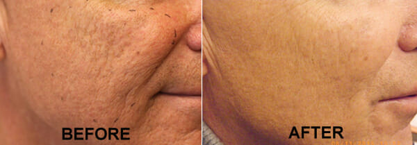 acne scar treatment edmonton laser
