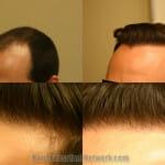 hair-transplant-surgery-photo-left-171243