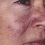 rosacea1aed