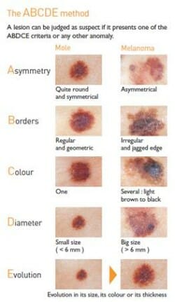 Icd Code For Mole