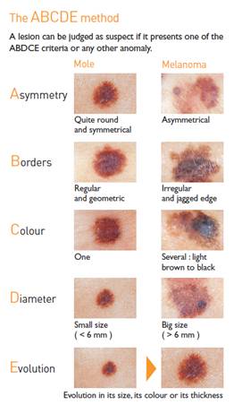 Abcde Mole Assessment