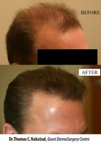 Hair Transplant Before and After