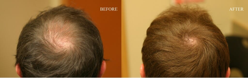 hair loss surgery crown thomas nakatsui