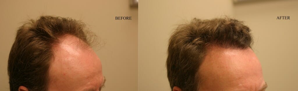 frontal scalp hair restoration edmonton