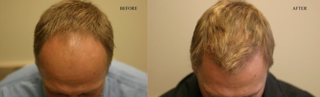 hair transplant surgery thomas nakatsui