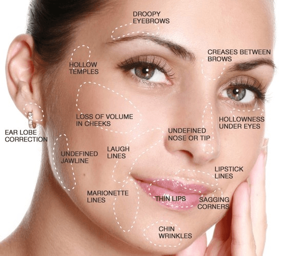 Juvederm facial fillers