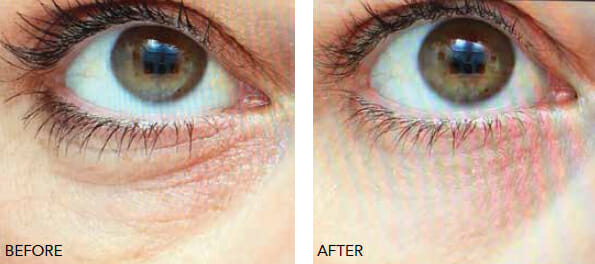 Redensity eyelid rejuvenation