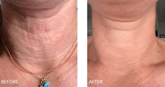 Redensity neck rejuvenation