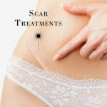 Scar treatment