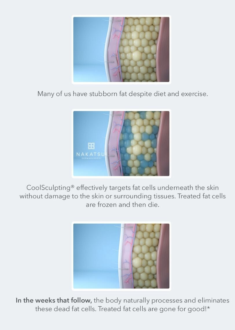 CoolSculpting infographic