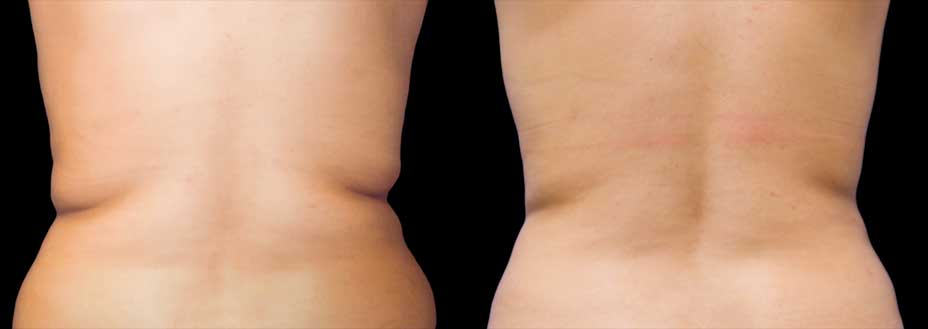 before and after photo love handles cryolipolysis Edmonton 