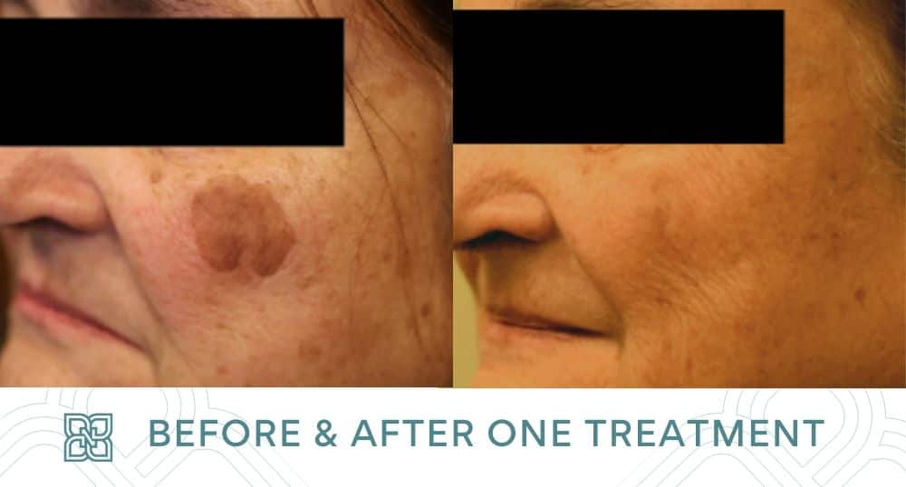 Brown and Red Spot Treatments Edmonton