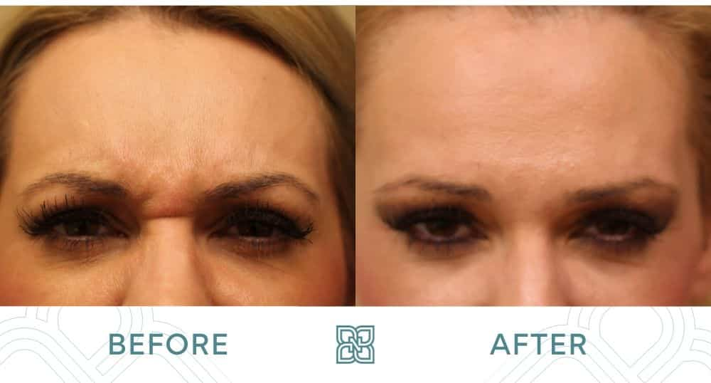 Botox frown lines edmonton before and after