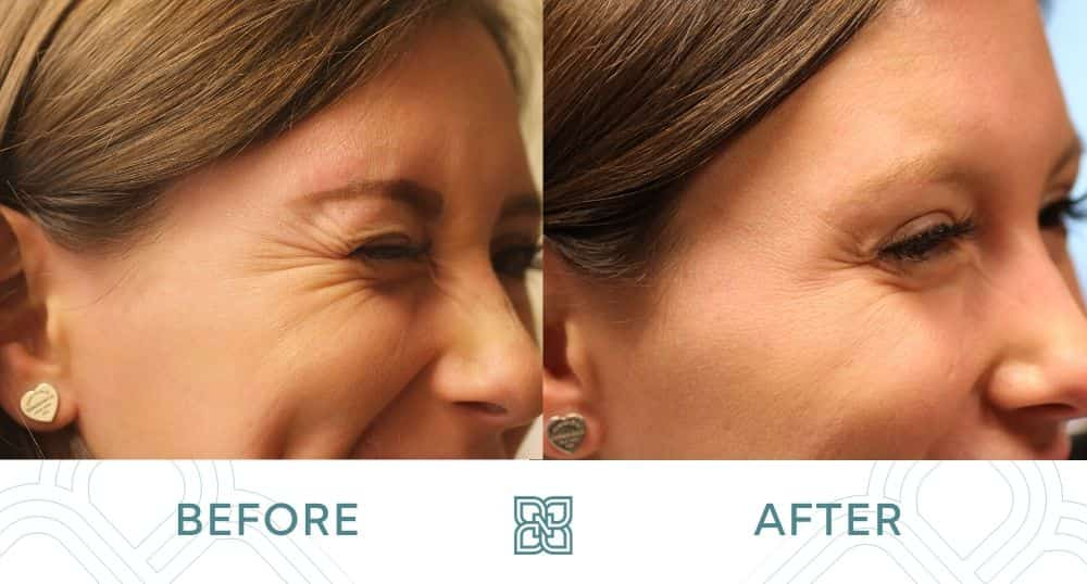 botox smile lines crow's feet around and under eyes before and after