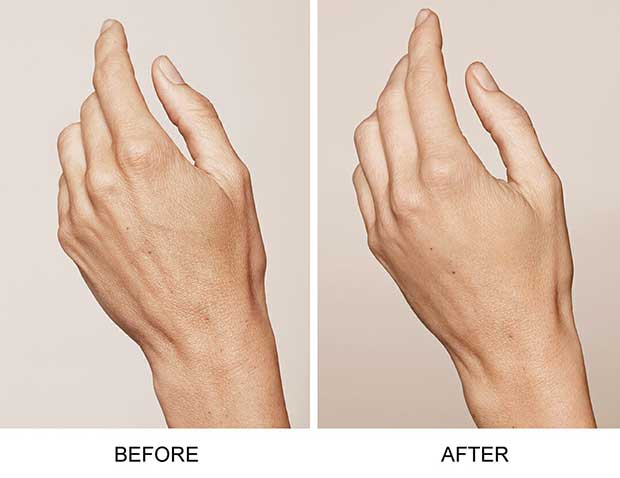 skin boosters RESTYLANE hands