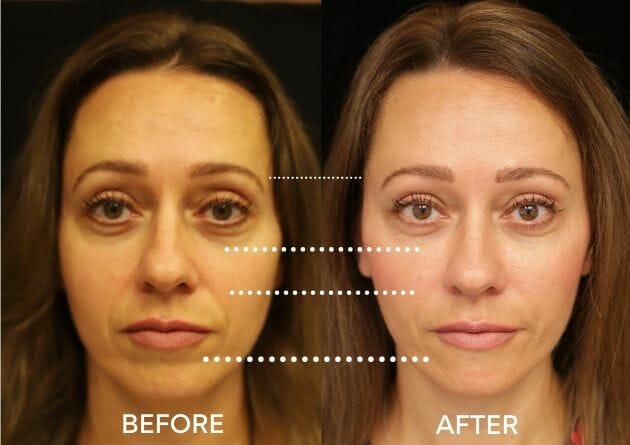 cheek and temple fillers before and after juvederm